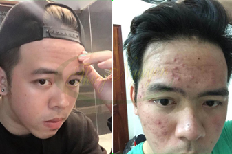 Cách trị mụn trứng cá, mụn bọc, mụn mũ, da nhiễm khuẫn nặng cho nam - MSKH: TN2966